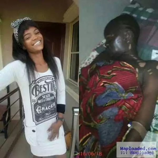 Graphic photos: Beauty queen gets severely burnt in gas explosion